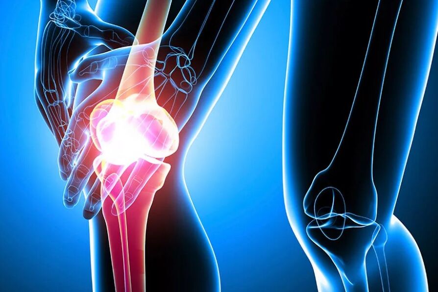 Arthrosis na gwiwa