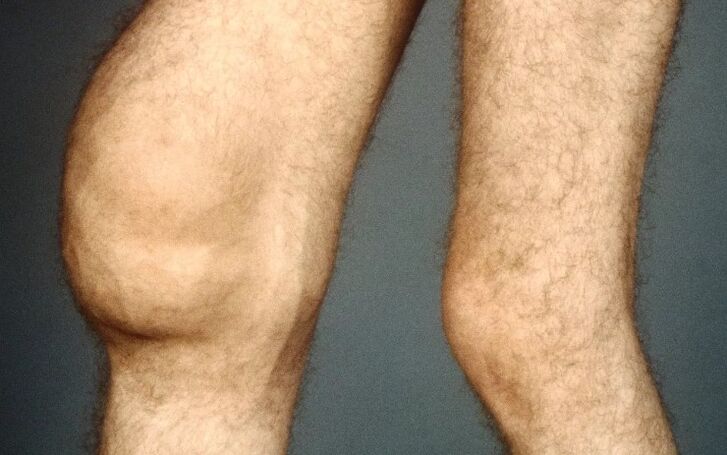 Post -tulatic arthrosis na gwiwa hadin gwiwa