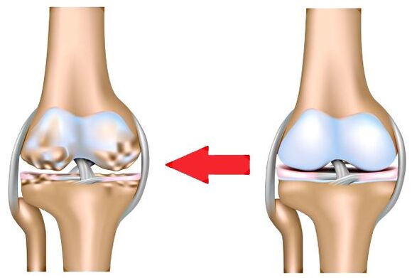 Lafiya hadin gwiwa da arthrosis