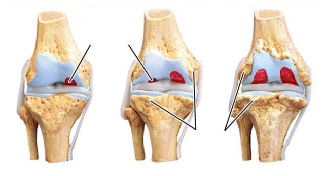 rikitarwa na arthrosis na gidajen abinci