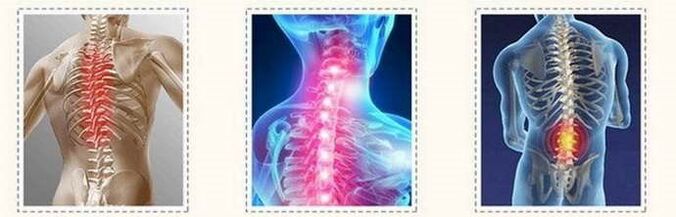 osteochondrosis spinal sparting lesions