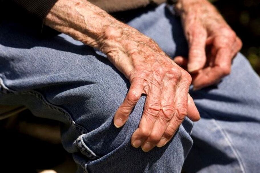 Arthrosis cuta ce mai alaƙa da shekaru wacce ke faruwa a cikin tsofaffi