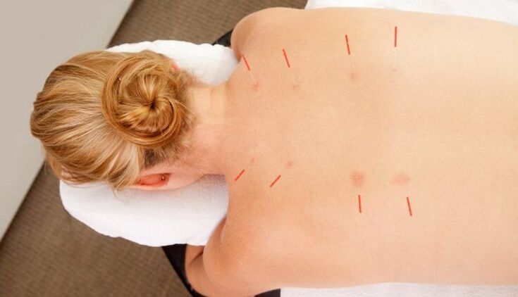 Acupuncture don thoracic osteochondrosis, wanda yana da fa'idodi da yawa