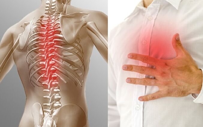 Osteochondrosis na thoracic yana bayyana ta ciwo da jin dadi a cikin kirji